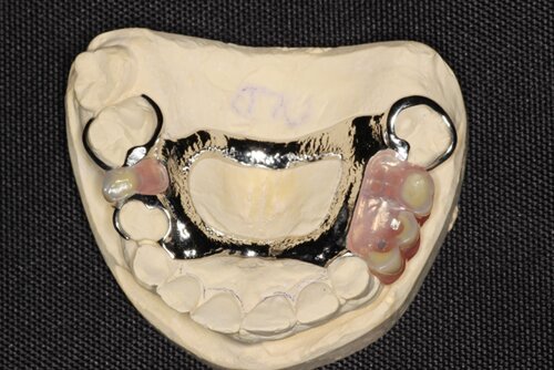 dentures